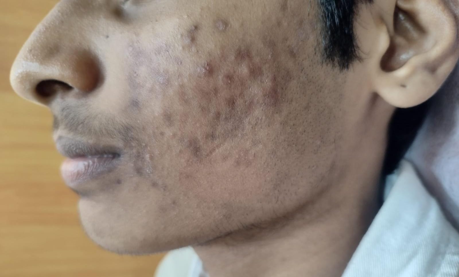 Before and after of acne and scar treatment at Dr. Faraah's clinic in Goregaon West, Mumbai